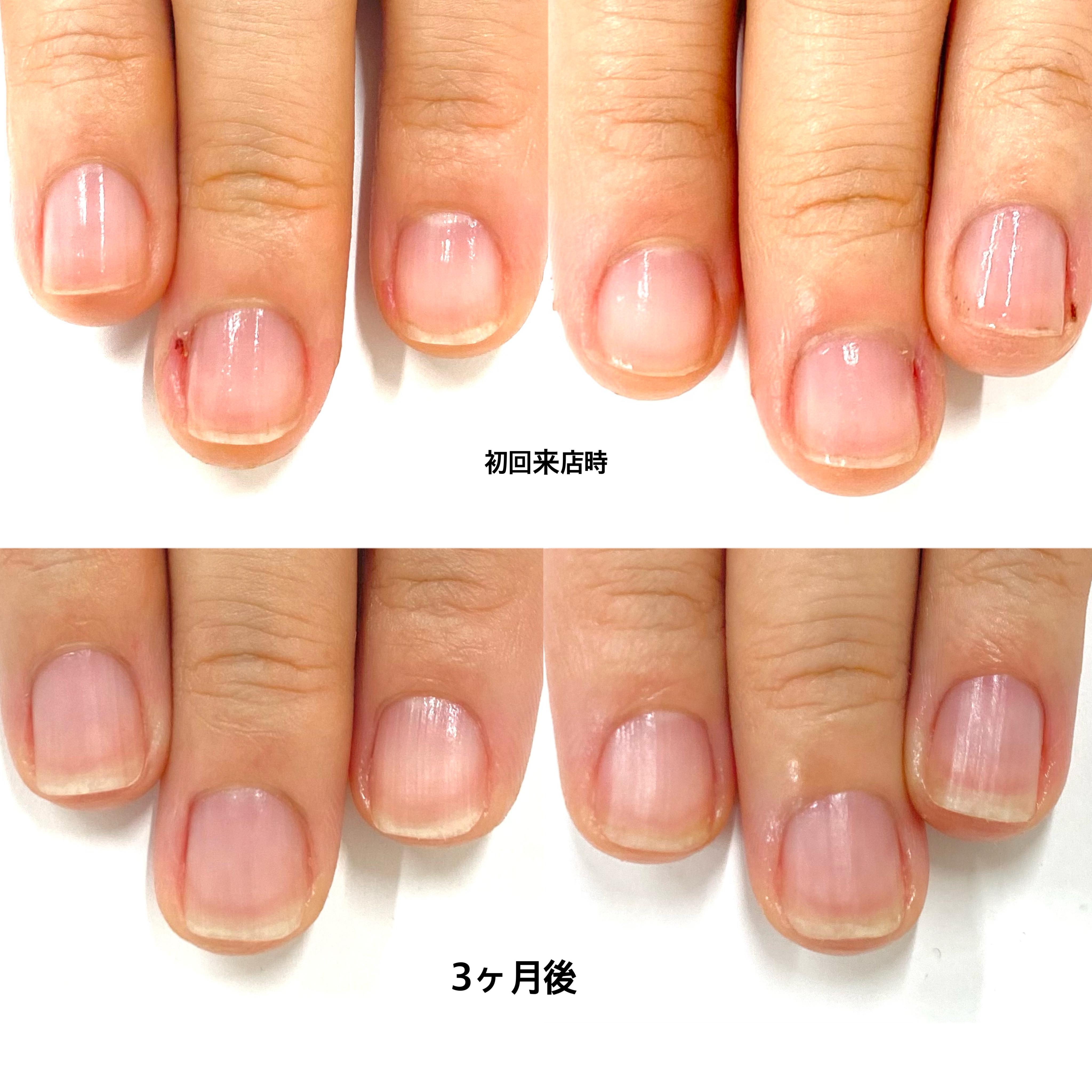今すぐお問い合わせを！あなたの爪の悩みを一緒に解決しましょう